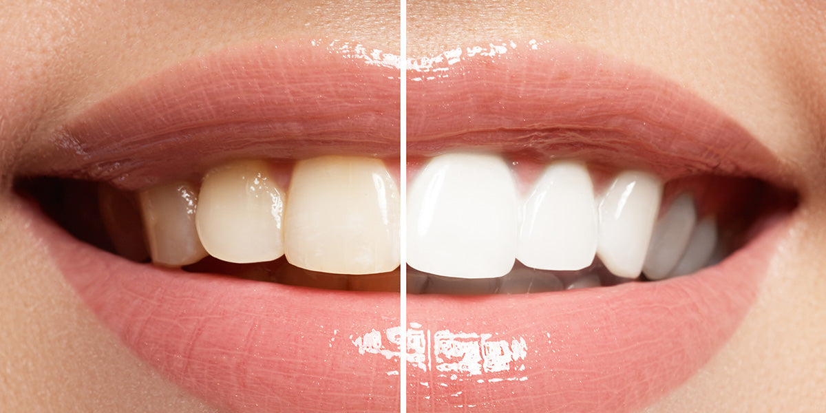 Still Using Ineffective Whitening Methods?